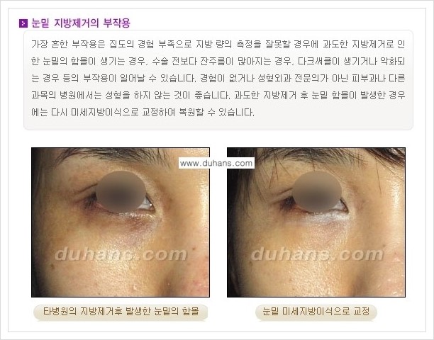 [두한성형외과 경쟁력 지방제거, 지방재배치] - [상큼하고 젊은 눈매 만들기 안내] 관련 이미지 11