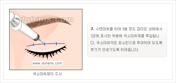 [두한성형외과 경쟁력 눈성형] - [퀵쌍꺼풀 안내] 관련 이미지 4
