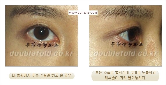 [두한성형외과 경쟁력 쌍꺼풀 재수술, 극한 재수술] - [쌍꺼풀 재수술에서 극복해야 할 극한의 상황과 문제들] 관련 이미지 20