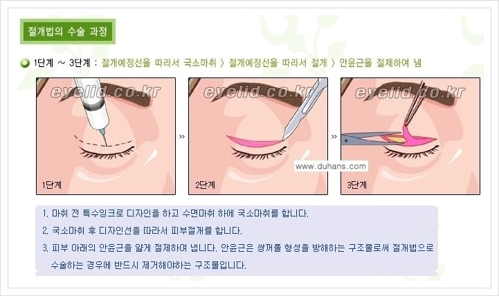 [두한성형외과 경쟁력 눈성형] - [절개법, 매몰법 쌍꺼풀 수술 안내] 관련 이미지 1