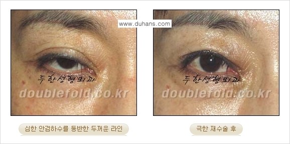 [두한성형외과 경쟁력 눈성형] - [극한의 상태에서 쌍꺼풀재수술(눈재수술) 안내] 관련 이미지 5