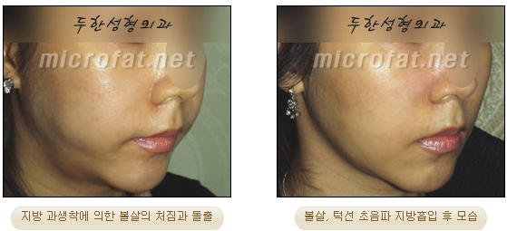 [Duhan Plastic Surgery Liposuction] - [Facial Liposuction] image 22
