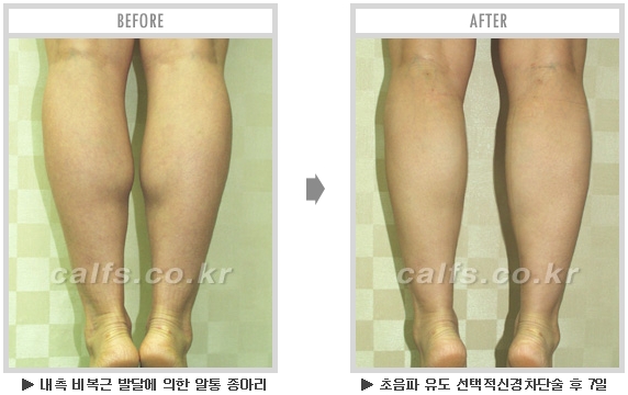 [종아리성형 두한성형외과] - [종아리수술에 대한 자주하는 질문과 답변 모음] 관련 이미지 59