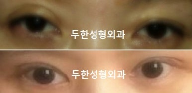 [DuHan Plastic Surgery Eye Surgery] - [Guide to Epicanthoplasty and Canthoplasty for Increasing the Horizontal Width of the Eyes] image 29