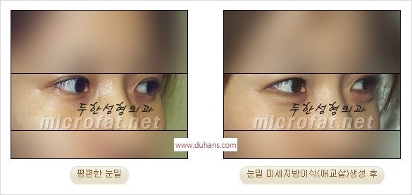 [두한성형외과 경쟁력 지방이식] - [두한 자가지방이식 클리닉 안내]​ 관련 이미지 38