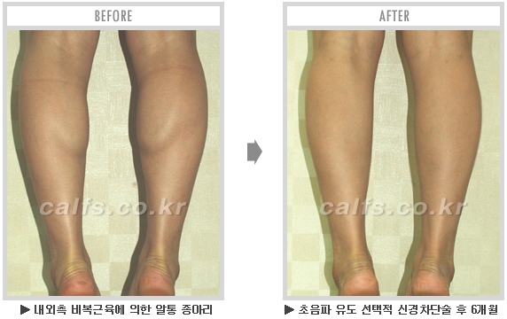 [종아리성형 두한성형외과] - [종아리수술에 대한 자주하는 질문과 답변 모음] 관련 이미지 64