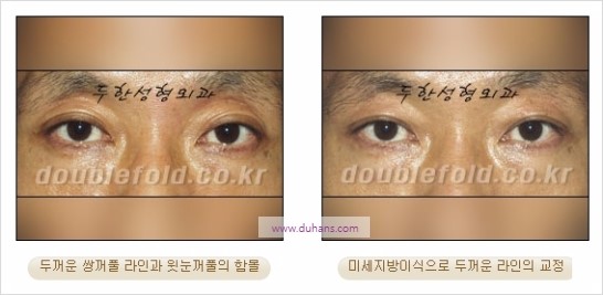 [두한성형외과 경쟁력 눈성형] - [쌍꺼풀 재수술에 대한 최선의 대안 제시] 관련 이미지 26