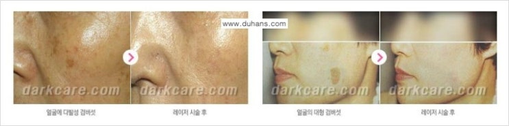 [두한성형외과 무한 경쟁력 다크써클 치료] - [다크써클 + 검버섯 레이저 콤비 프로그램] 관련 이미지 6