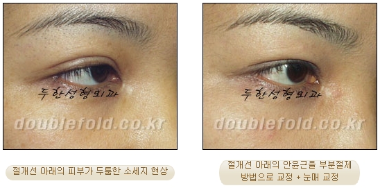 두한성형외과 쌍커풀 재수술 - 눈매교정 재수술 관련 이미지 70