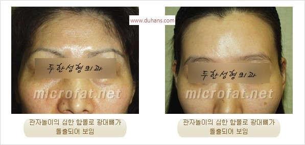 [두한성형외과 경쟁력 미세지방이식] - [관자놀이(측두부) 지방이식] 관련 이미지 1