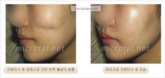 [두한성형외과 경쟁력 지방이식] - [두한 자가지방이식 클리닉 안내]​ 관련 이미지 80