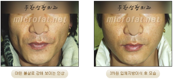 얼굴지방이식 두한성형외과 - 볼지방이식 관련 이미지 34