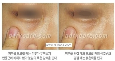 [두한성형외과 경쟁력 눈밑성형] - [눈밑 다크써클 원인과 눈밑 다크써클 치료 방법 안내] 관련 이미지 2