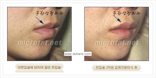 [두한성형외과 경쟁력 미세지방이식] - [입술 미세지방이식 안내 2.] 관련 이미지 8