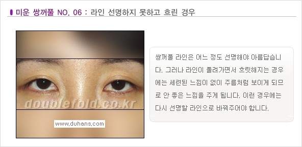 [두한성형외과 경쟁력 쌍꺼풀 재수술, 극한 재수술] - [일반적인 기준의 미운 쌍꺼풀과 아름다운 쌍꺼풀 안내] 관련 이미지 6
