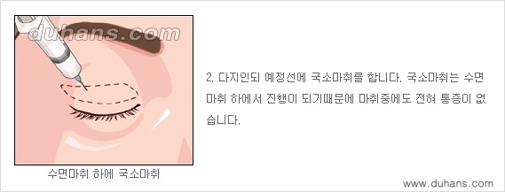 [두한성형외과 경쟁력 눈성형] - [상큼하고 환한 젊은 눈매 상안검성형(윗눈꺼풀 처짐) 안내] 관련 이미지 2