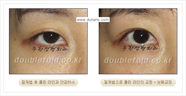 [두한성형외과 경쟁력 쌍꺼풀 재수술, 극한 눈재수술] - [풀린 쌍꺼풀 라인 교정수술 안내] 관련 이미지 3