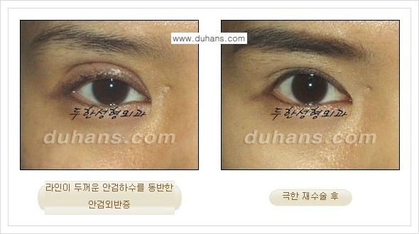 [두한성형외과 경쟁력 쌍꺼풀 재수술, 극한 재수술] - [망친 눈 복원 극한 재수술 안내] 관련 이미지 1