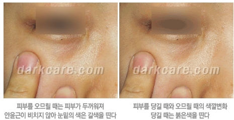 Duhan Plastic Surgery Dark Circle Improvement - What Causes Dark Circles? What Types of Dark Circles Are There? image 3
