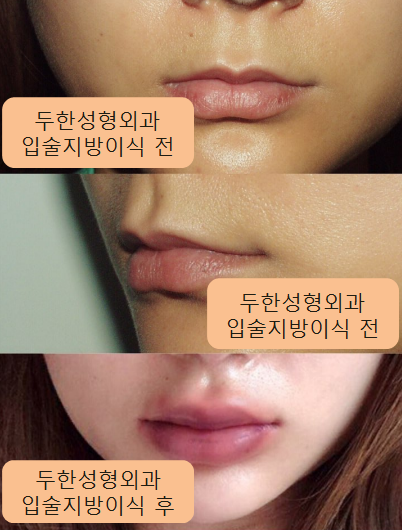 [입술 지방이식 두한ps]-#도톰한입술 #입술지방이식 관련 이미지 1
