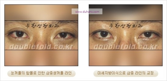 [두한성형외과 경쟁력 눈성형] - [쌍꺼풀 재수술 과정과 쌍꺼풀 재수술 실패의 원인, 쌍꺼풀 재수술의 성공 요건] 관련 이미지 57