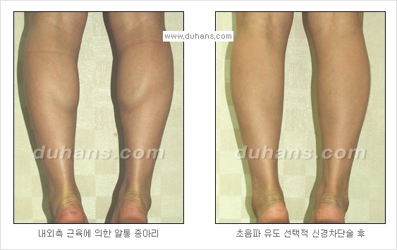[두한성형외과 경쟁력 멀티종아리성형] - [종아리 퇴축수술 방법들의 문제점] 관련 이미지 15