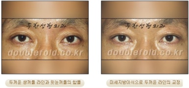 [Duhan Plastic Surgery Revision Double Eyelid Surgery] - [Double Eyelid Revision Surgery Process] image 33