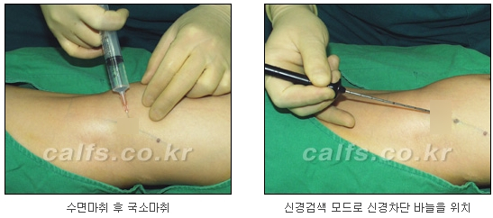 [종아리알제거 두한성형외과] - [초음파유도선택적신경차단술] 관련 이미지 7