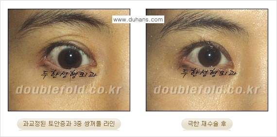[두한성형외과 NO.1 경쟁력 눈성형] - [일반 쌍꺼풀 재수술과 극한 눈(쌍꺼풀) 재수술과의 차이점] 관련 이미지 11
