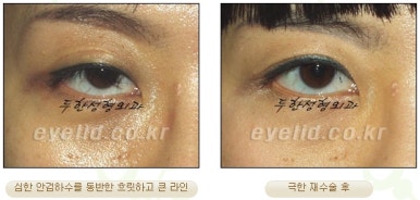 Duhan Plastic Surgery Ophthalmic Reoperation - What Is a Successful Double Eyelid Revision Surgery? image 28