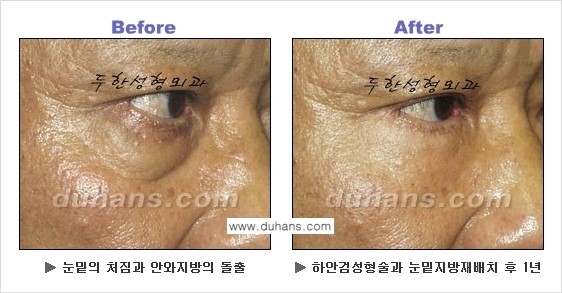 [두한성형외과의 상큼하고 환한 젊은 눈매완성] - [하안검 성형술 ②] 관련 이미지 14