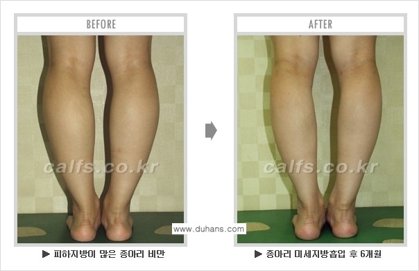 [두한성형외과 매력적인 종아리 만들기!] - [정교한 흡입 - 미세흡입관 지방흡입술 3.] 관련 이미지 10