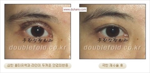 ​[두한성형외과 눈재수술] - [앞트임복원, 뒤트임복원, 쌍꺼풀복원] 관련 이미지 30