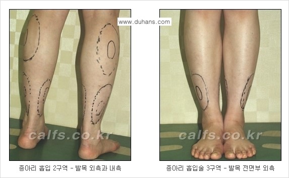 ⁠⁠[두한성형외과 경쟁력 멀티종아리성형] - [지방흡입이 필요한 종아리 비만 안내] 관련 이미지 4