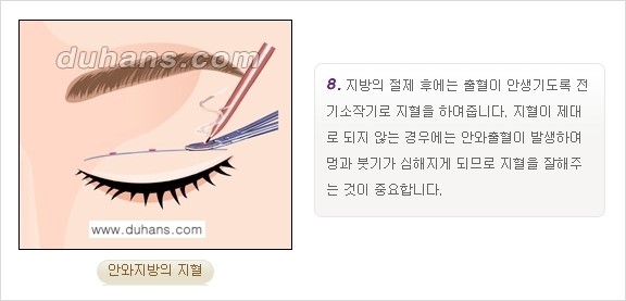 [두한성형외과 경쟁력 눈성형] - [쌍꺼풀 재수술 방법 - 부분절개법(Partial incision method) 과정 안내] 관련 이미지 9