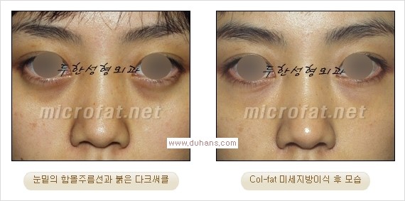 [두한성형외과 경쟁력 눈밑성형] - [눈밑이 전반적으로 함몰된 다크써클 교정 안내] 관련 이미지 13