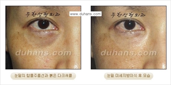 [두한성형외과 경쟁력 미세지방이식] - [다크써클 & 눈밑주름 미세지방이식 4.] 관련 이미지 12