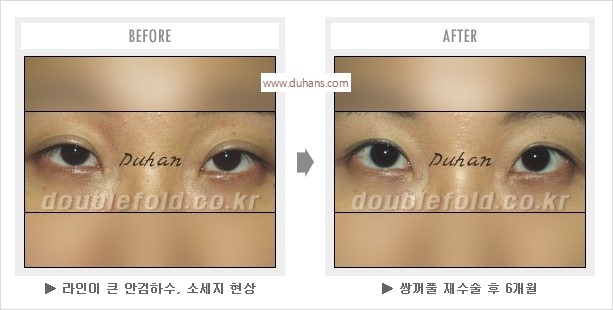 [두한성형외과 경쟁력 눈성형] - [나에게 맞는 어울리는 쌍꺼풀 라인] 관련 이미지 20