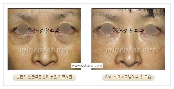 [두한성형외과 경쟁력 눈밑성형] - [눈밑 다크써클과 눈밑 함몰주름의 최적화 교정방법 안내] 관련 이미지 14