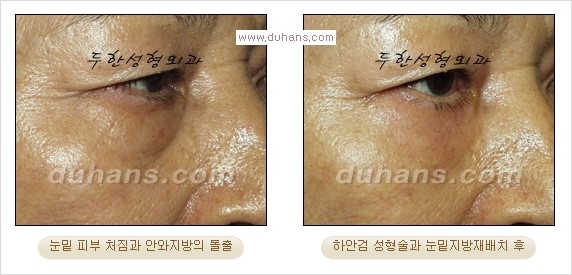 [두한성형외과 경쟁력 다크써클 교정] - [젊어 보이면서 개선된 인상을 주는 하안검 성형술] 관련 이미지 15