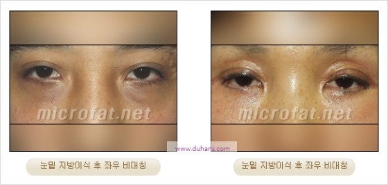 [두한성형외과 경쟁력 지방이식] - [두한 자가지방이식 클리닉 안내]​ 관련 이미지 58