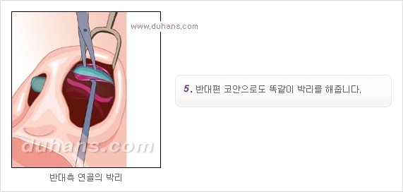 [두한성형외과 경쟁력 코성형] - [코성형을 위한 알로덤(슈어덤) 수술, 실리콘 수술 안내] 관련 이미지 8