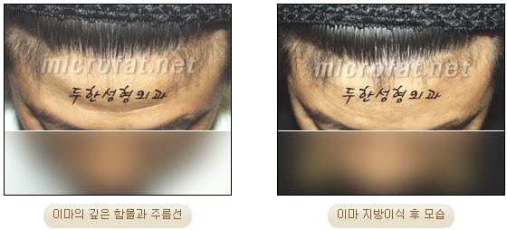[두한성형외과 이마성형] - [엔도타인리프팅, 이마지방이식]​ 관련 이미지 31