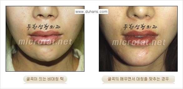 [두한성형외과의 경쟁력 미세지방이식] - [무턱교정 - 턱 미세지방이식 안내 1.] 관련 이미지 5