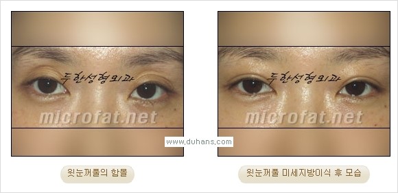 [두한성형외과 경쟁력 미세지방이식] - [꺼진(함몰된) 윗눈꺼풀 미세지방이식] 관련 이미지 15