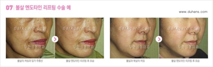 ​[두한성형외과 무한 경쟁력 다크써클 치료] - [다크써클 + 리프팅(엔도타인) 콤비 프로그램] 관련 이미지 7