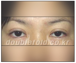 [Duhan Plastic Surgery Reoperation for Double Eyelids] - [Lowering the Double Eyelid Line] image 1