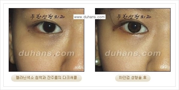 [두한성형외과 경쟁력 눈성형] - [젊은 눈매로의 복원 안검성형] 관련 이미지 37