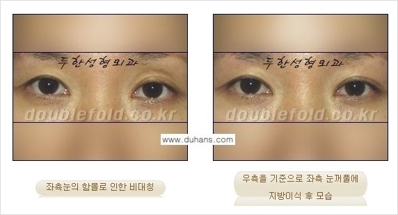 [두한성형외과 경쟁력 쌍꺼풀 재수술] - [쌍꺼풀 재수술 과정] 관련 이미지 98