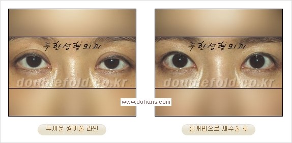 [두한성형외과 경쟁력 쌍꺼풀 재수술] - [쌍꺼풀 재수술 과정] 관련 이미지 67